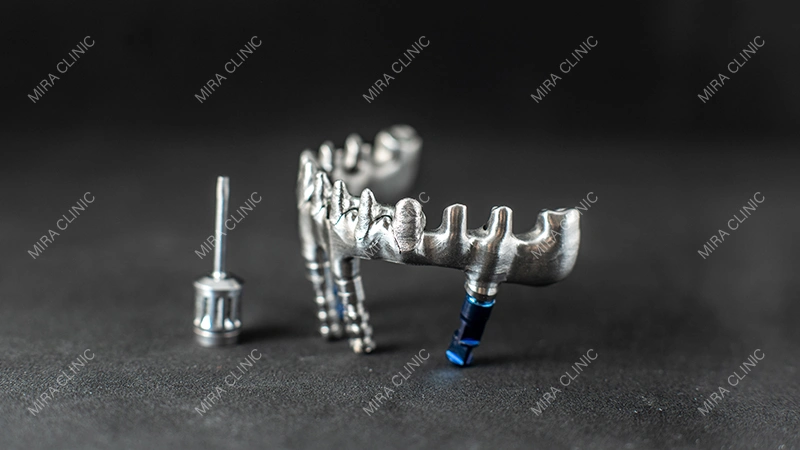 Titanium Bar in Dental Implant